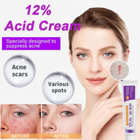 Acne Treatment for Spot Prone Skin,12% Acid Spot Cream,Anti Acne,Rosacea Cream for Face,Pimple Crea-m,Dark Spo-t Remover,Daily Face Moisturiser for Blemish Control,Blackhead Remover,Even Skin Tone
