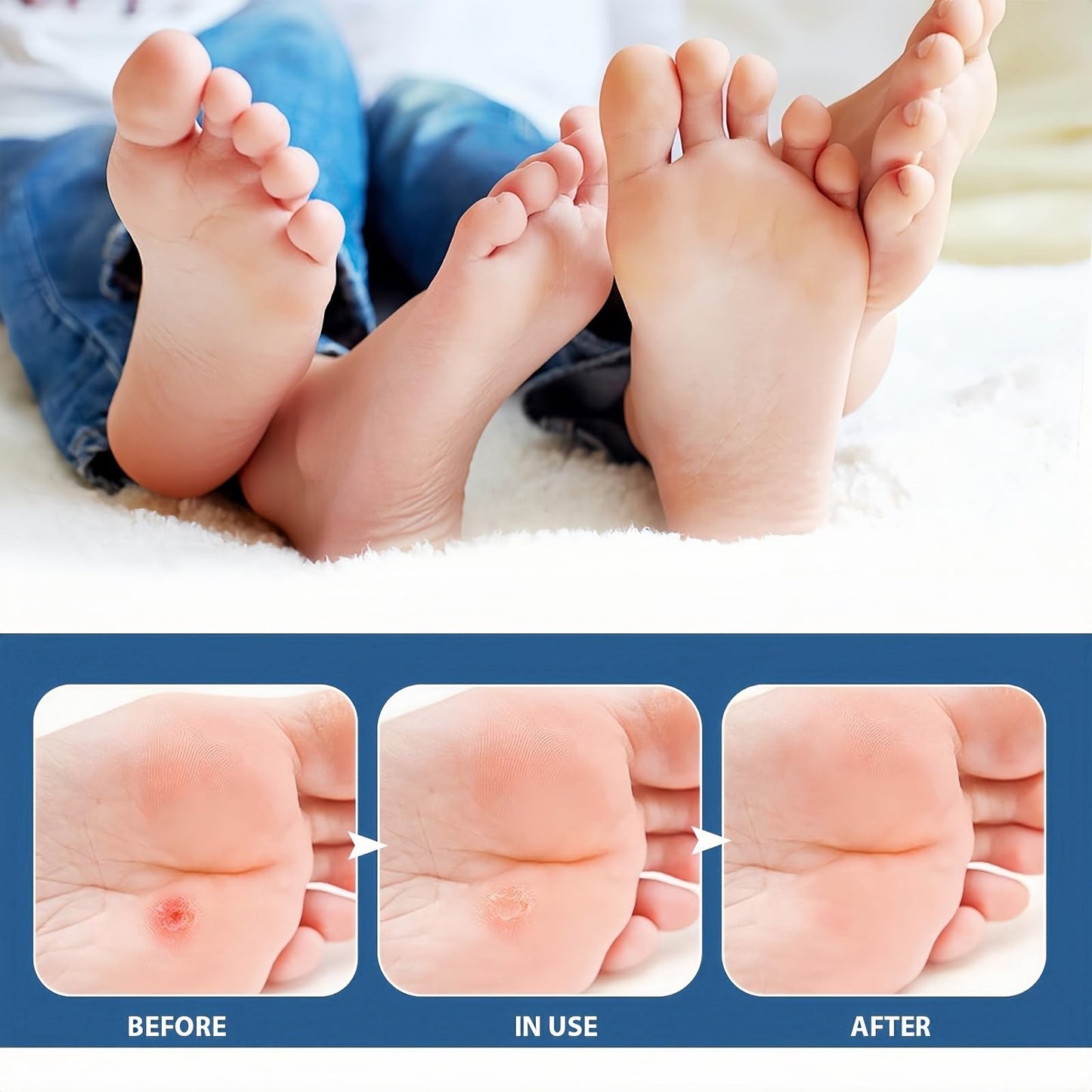 Xunzhi 24pcs Wart Treatment Patch,Corn Remover Pads,Verruca Treatment Corn Plasters,Foot C/ORN Remover Patch C/ORN,Wart R/emover,Co/rn Callus R/emover,Pain Relief W/Art Plaster,Co/rn Plasters for Toes