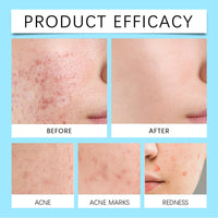 Retinol Gel,Retinol Acne Treatment Gel & Skin Soothing Cream,Retinol Moisturizer Cream,Spot Cre/am for Acne,Anti Acne G/el,Anti Acne Face Cr/eam,Ac/ne Treatment for Face,Acn/e Foaming Wash,Blemish