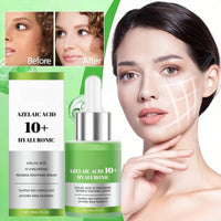 Fankayi Azelaic Acid 10 Hyaluron Redness Soothing Serum,Facial Serum for Sensitive Skin,Dark Spot Correcting Serum,Hyaluronic Acid Serum,Hyaluronic Acid Moisturiser,Gentle and Soothing,Light in Texture