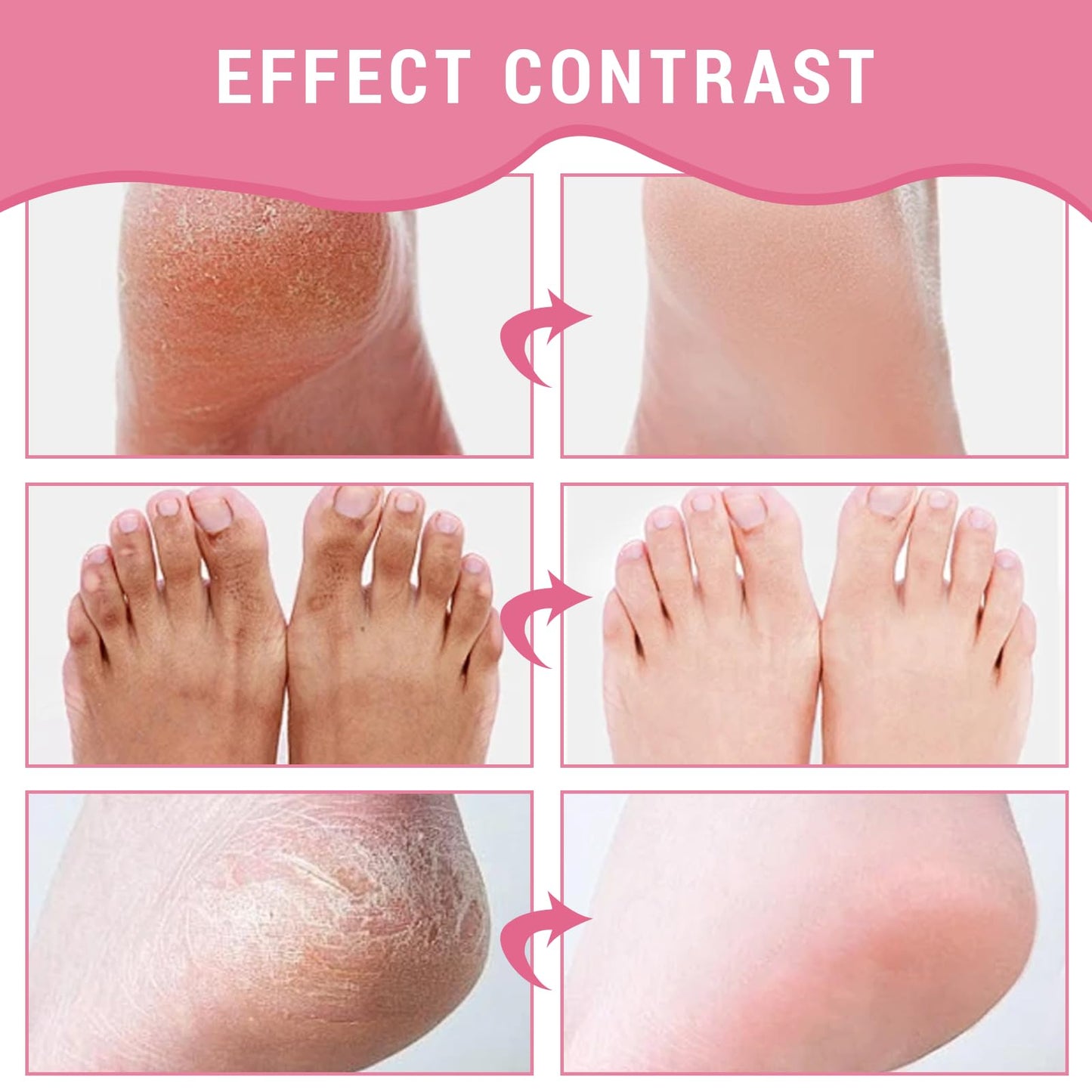 Benaewa 2 Pcs Urea Foot Cream, Foot Moisturiser for Cracked Heel Repair, Dry Skin Care