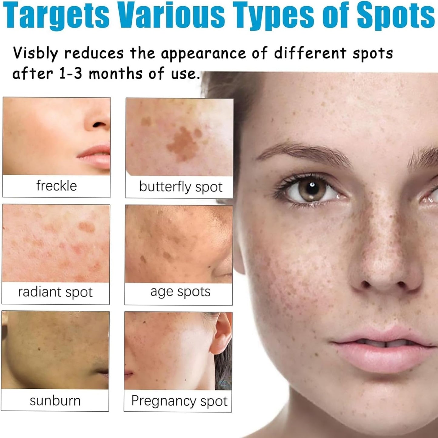 QinZiEn Anti-Hyperpigmentation Cream,Cream for Hyperpigmentation Treatment,Anti Aging Face Cre/am,Moisturiser Face Women,Dark Spot Remover,Wrinkle Filler Face Moisturiser,Intense Face Moisturiser 30g