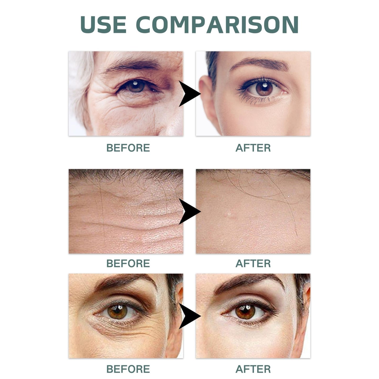 Cureluxe Pack of 5 Dissolving Microneedle Eye Patches,Dissolving Microneedle Eye Patches with Peptides,Hyaluronic acid,Glycerin,Anti Wrinkle Pat-ches,Under Eye Pat-ches for Dark Circles & Puffy Eyes