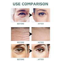 Cureluxe Pack of 5 Dissolving Microneedle Eye Patches,Dissolving Microneedle Eye Patches with Peptides,Hyaluronic acid,Glycerin,Anti Wrinkle Pat-ches,Under Eye Pat-ches for Dark Circles & Puffy Eyes