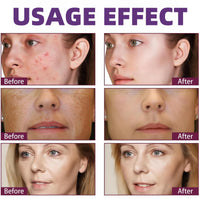 Fankayi Azelaic Acid Serum Cream,Face Hyaluronic Acid for Redness & Dark Spots,Brightening Face Skin Care Treatment,Dark Spot Remover,Brightening Serum,Whitening Freckle Cream,Dark Spot Correcting Serum