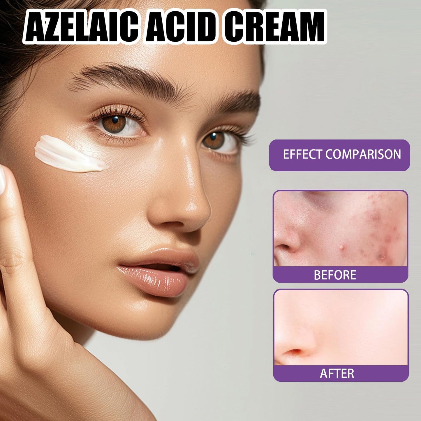 AuraBeen 12% Acid Spot Cream - Even Skin Tone, Suitable for All Skin Types - Improve Dullness, Zits, Red Dots - Zits Cream for Clearer Complexion