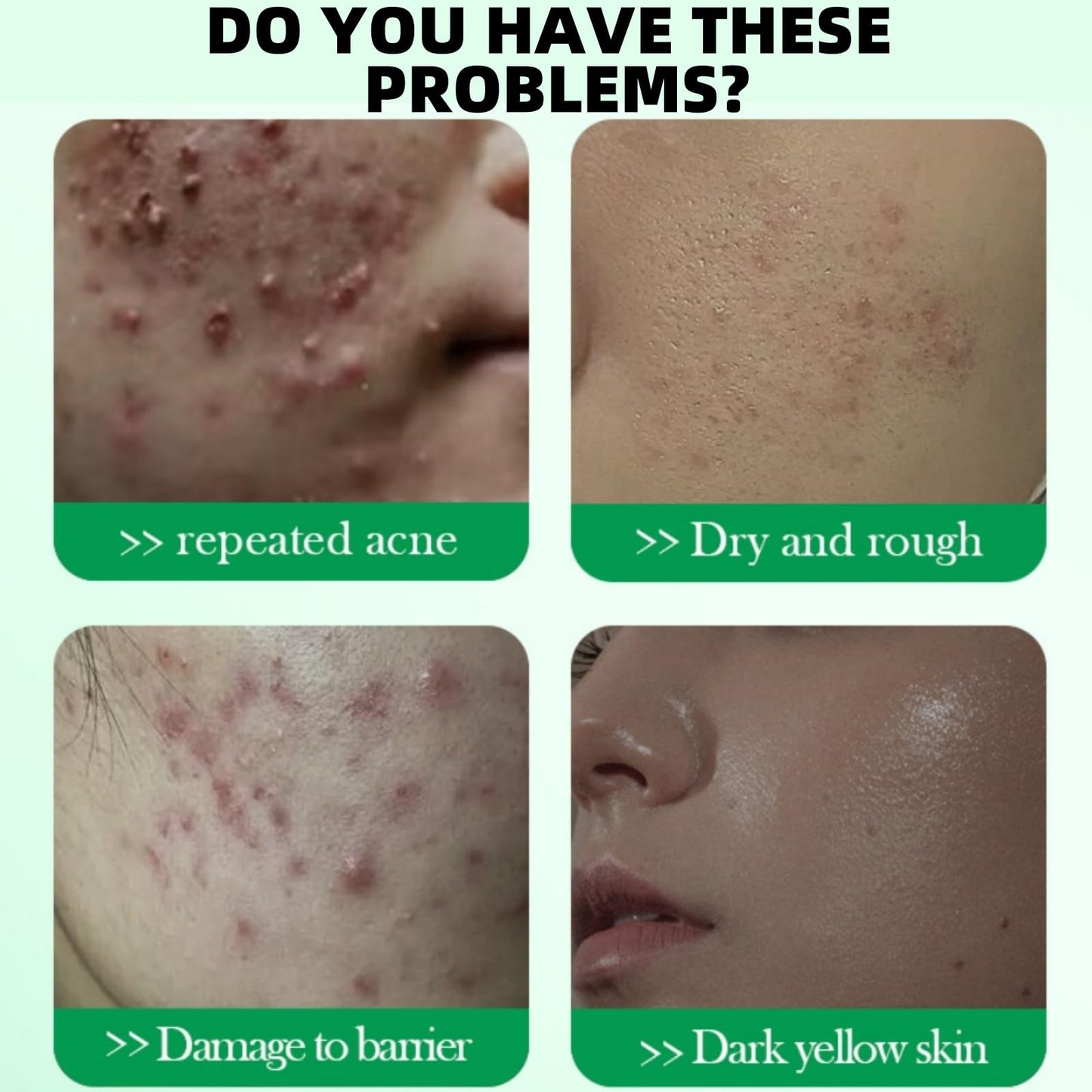 50g Salicylic Acid Acne Cream,3% BHA Spot Cream for Acne,Anti Redness Crea-m for Face,Ac-ne Scar Removal Cre-am,Pimple Cre-am for Redness,Moisturizing Face Cr-eam for Women,Dark Spot Remover for F-ace
