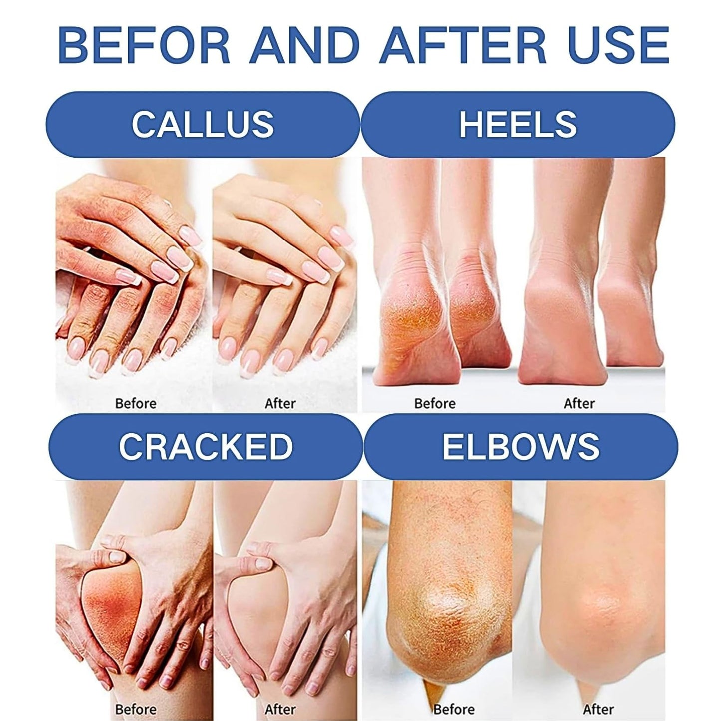 MrCuvaryas Urea Foot Cream 60 Percent Heel Balm Stick Set & Foot File Set, Urea Cream for Feet, 2% Salicyl - ic Acid Foot Cream for Cracked Heels and Dry Skin Cracked Heel Repair Cream Stick, Foot Moisturiser