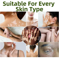 Yoowan Treatment Cream,Freckle Removal Cream,Freckle Remover,Skin Barrier Repair Cr-Eam,Effectively Alleviate The White Blemishes On The Skin,Daily Repair Balm,Deep Moisturizing For Dry Face And Body