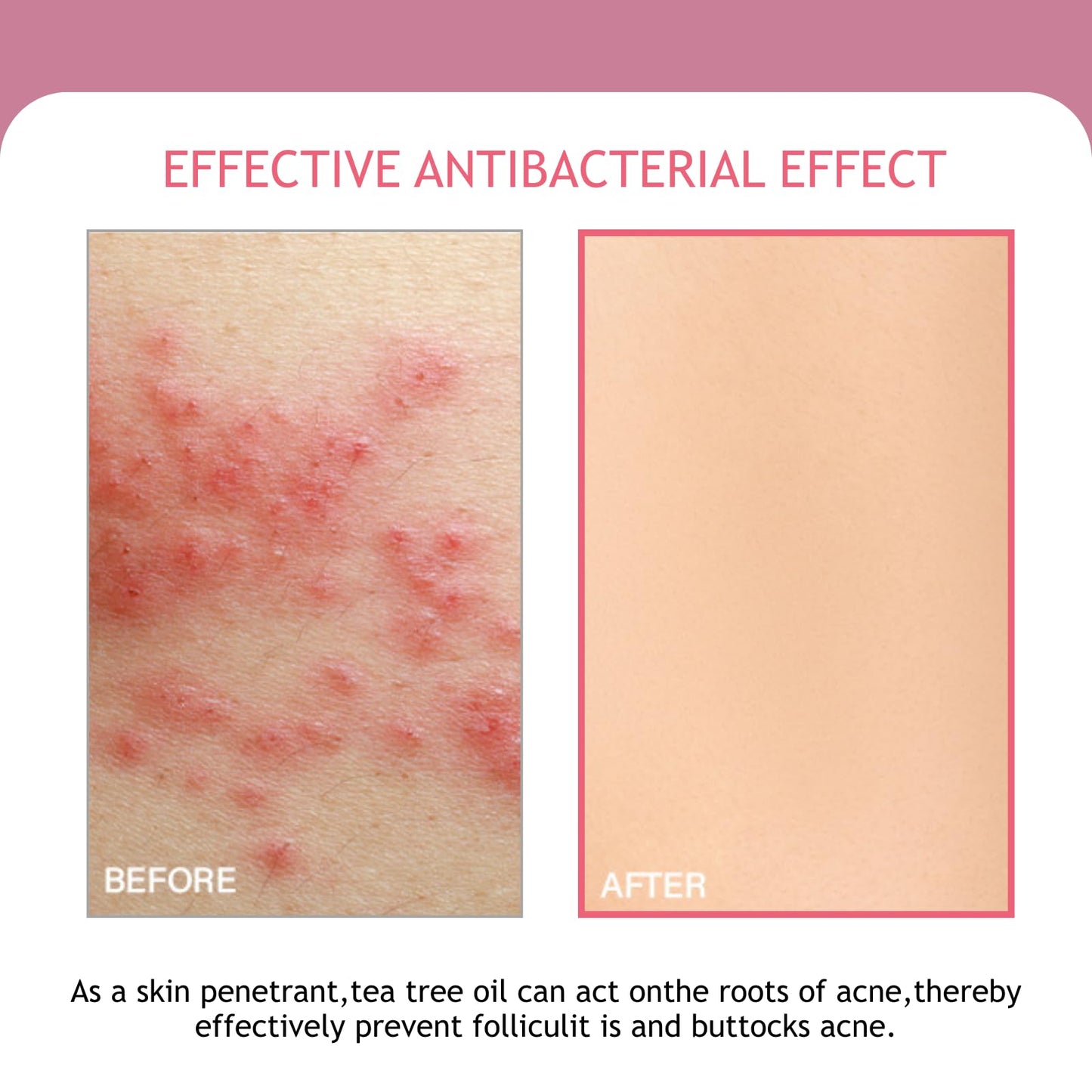 Butt Acne Cream 100ml, Butt Acne Treatment for Women with Tea Tree Oil, Body Acne Lotion for Back and Thighs, Acne Scar Cream and Pimple Spot Treatment for Smooth Clear Skin