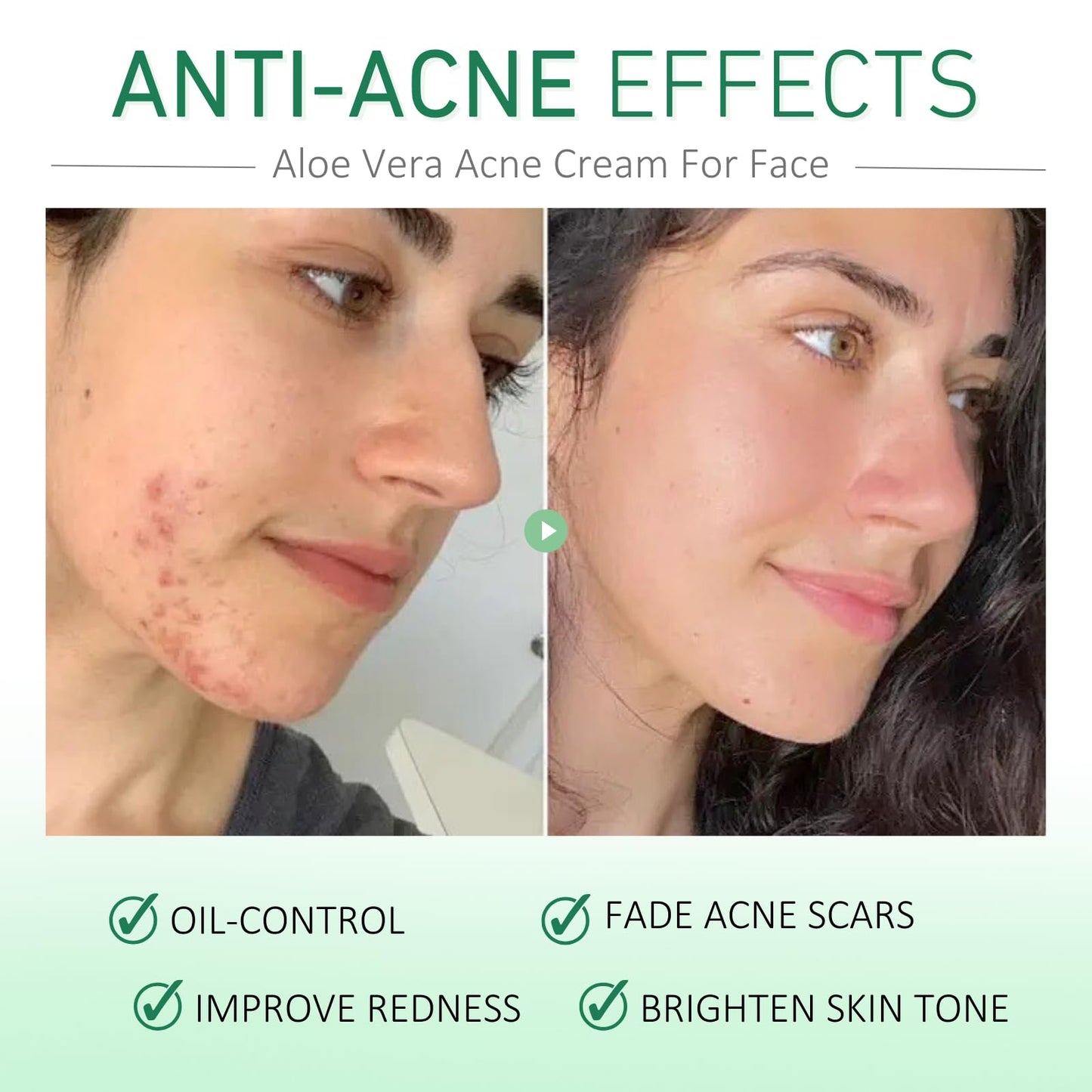 Trendyfave 2pcs Acne Scar Treatment Gel, Acne Aloe Vera Gel For Face, Acne Scar Removal Cream, Aloe Vera Cream For Acne, Pimples, Face Blemishes, Blackheads, Acne Treatment Acne Cream - 20g/0.76oz