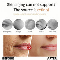 Epi-glow Advanced Anti-Hyperpigmentation Cream,Mela-nex Cream for Hyperpigmentation Treatment,Anti Aging Face Cre-am,Retinol Moisturiser,Retinol Serum for Face,Retinoid Cre-am