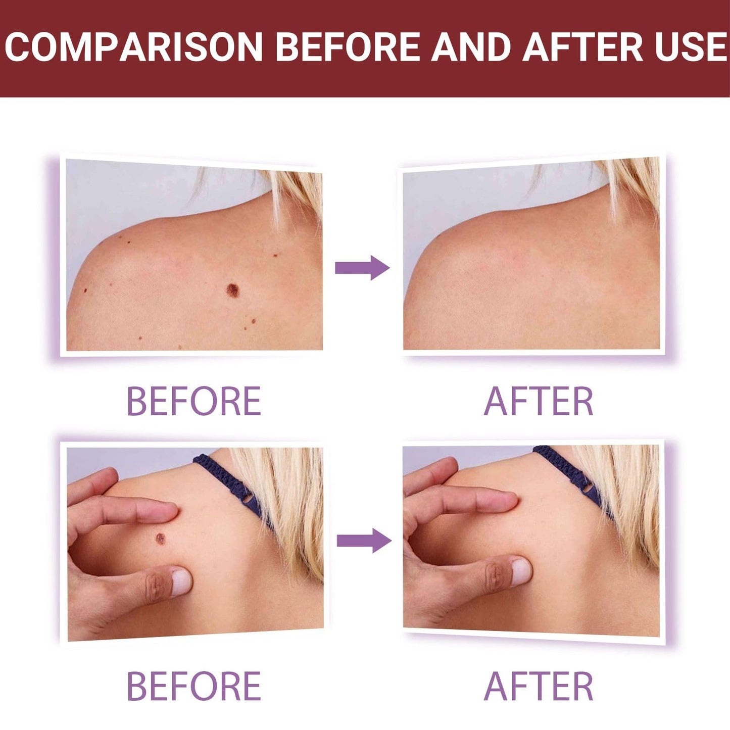 Wart Remover Cream,Effective Wart Removal,Mole Remover,Fast Effective Safe Skin Mole Removal,Wart Treatment for Face & Hands & Body,Wart Remover for Hands,Wart Re-Mover for Face,Flat Wa-rt Remover