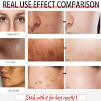 Tianyue Freckle Removal Cream,Anti-Freckle Crea-m- Dark Spot Removal Cream with Niacinamide & Vitamin C,Dark Spot Remover for Face & Body,Whitening Freckl-e Crea-m, Reduces Melasma,Improve Skin Dullness