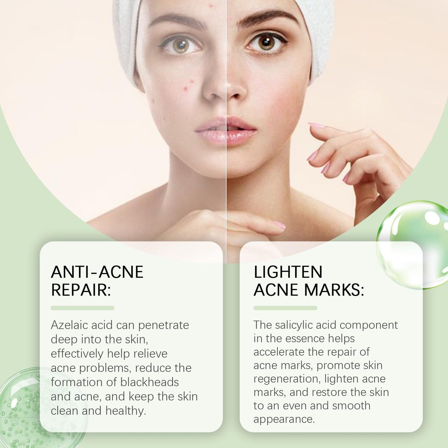 Siyinzu Acid Face Cream,10% Acid Gel For Facial and Skin Care,Ac/id 10% Acne Tratment Ge/l,Anti Acne G/el for Spot Prone Sk/in,Brightening Face S/kin Care Treatment,Dark Spot Serum Cream for Face