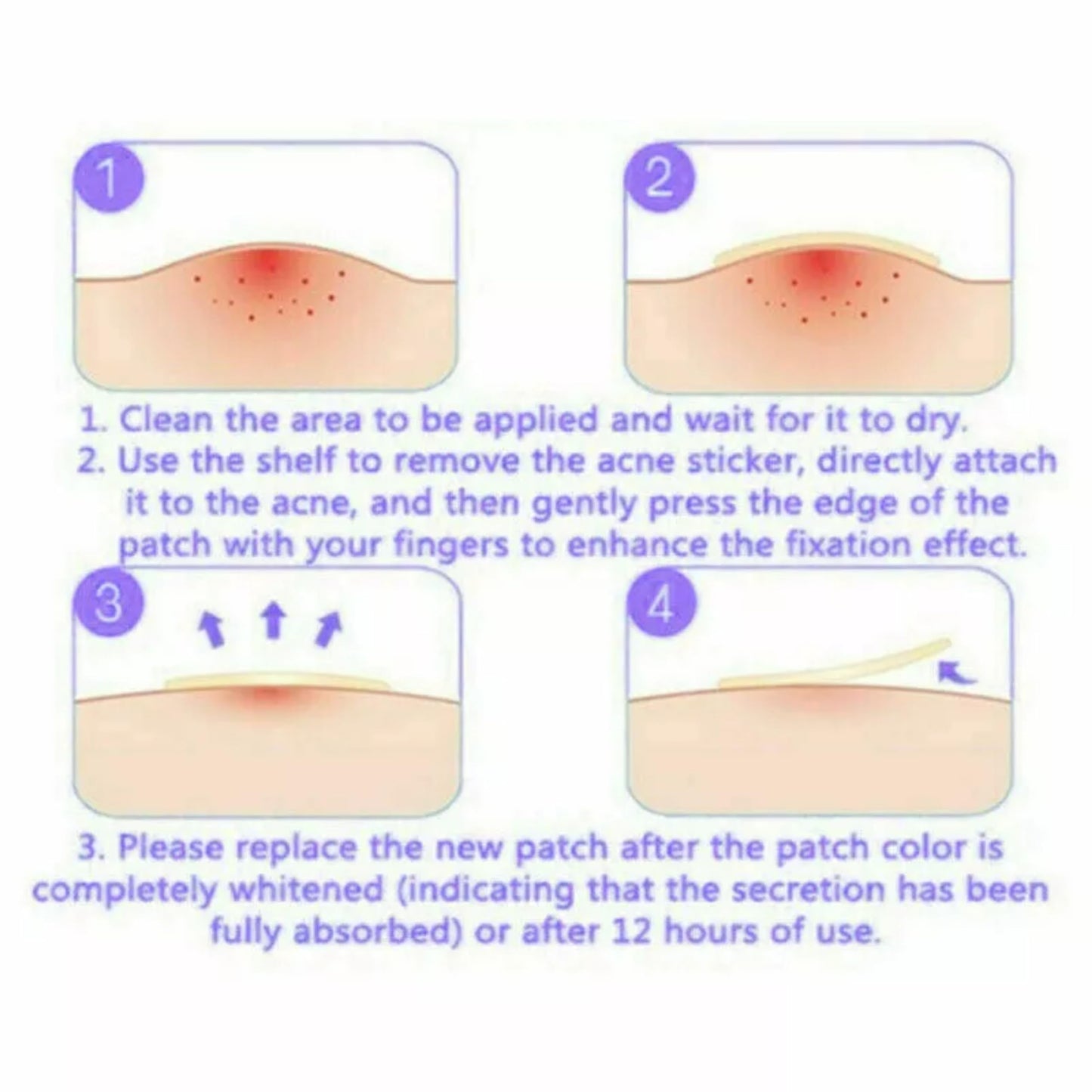 Generic Acne Patches - Pack of 24 Translucent Hydrocolloid Pimple Patch Spot Treatment Stickers for Face and Body - Fast-Acting, Vegan & Cruelty Free Skin Care