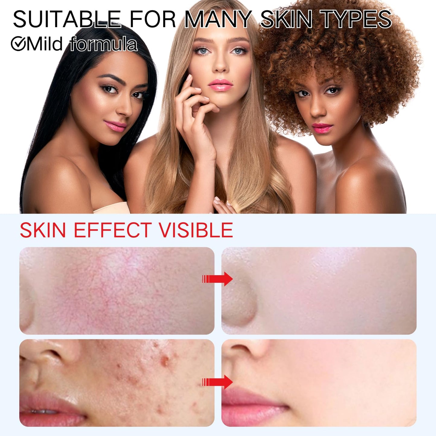 Cureluxe 15% Acid Acne Treatment Cream with Niacinamide & Vitamin C - Anti-Acne Face Cream for Spot-Prone Skin - Hydrating Serum for Clear Skin - Moisturizing Face Cream Daily Skincare