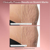 StriVectin SD Advanced™ Plus Intensive Moisturizer for Wrinkles & Stretchmarks, For Face & Body, Collagen Boosting with Peptides & Hyaluronic Acid