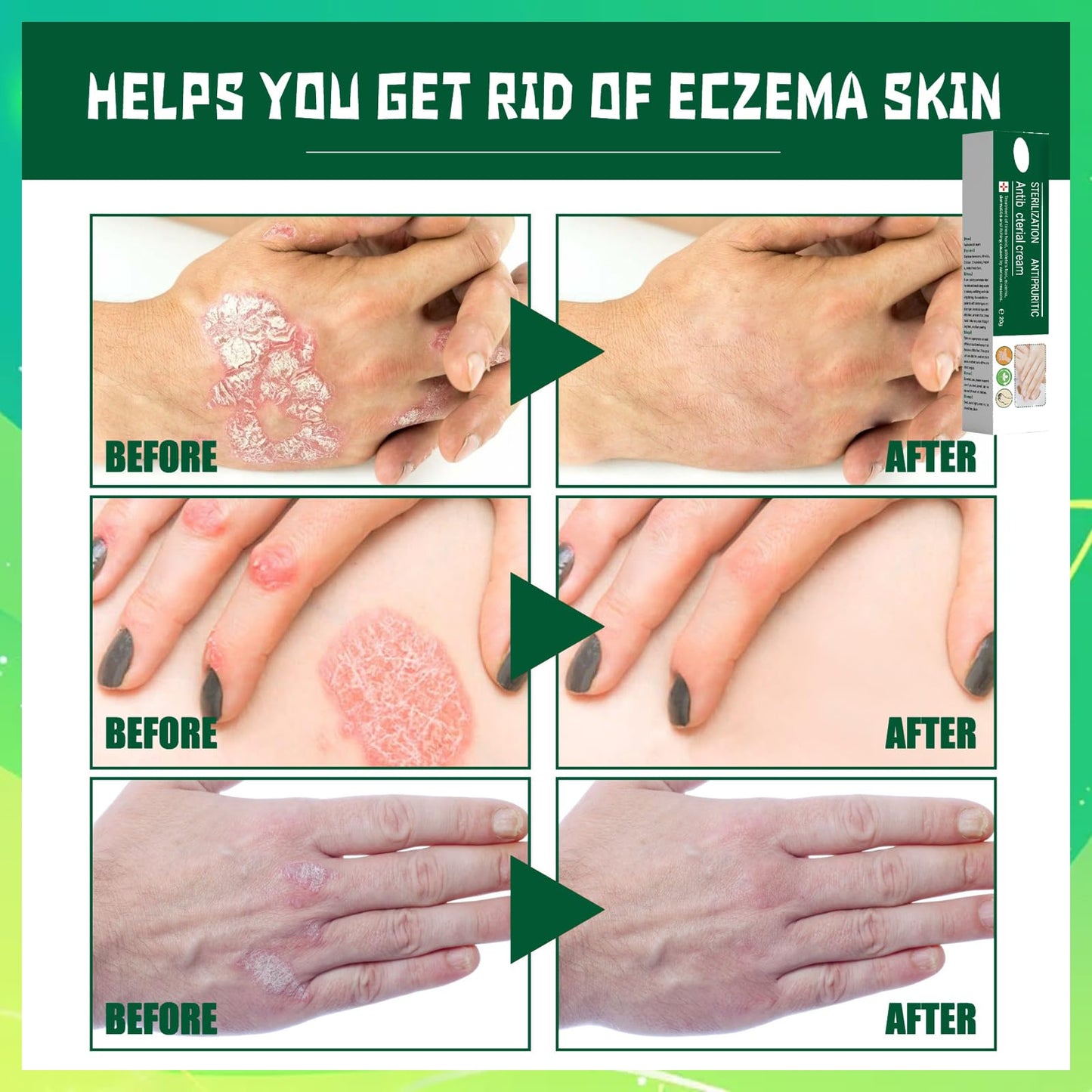 Athlete's foot Treatment cream - anti fungal foot cream for dry Feet, cracked heel Treatment & Athletes foot cream extra strong