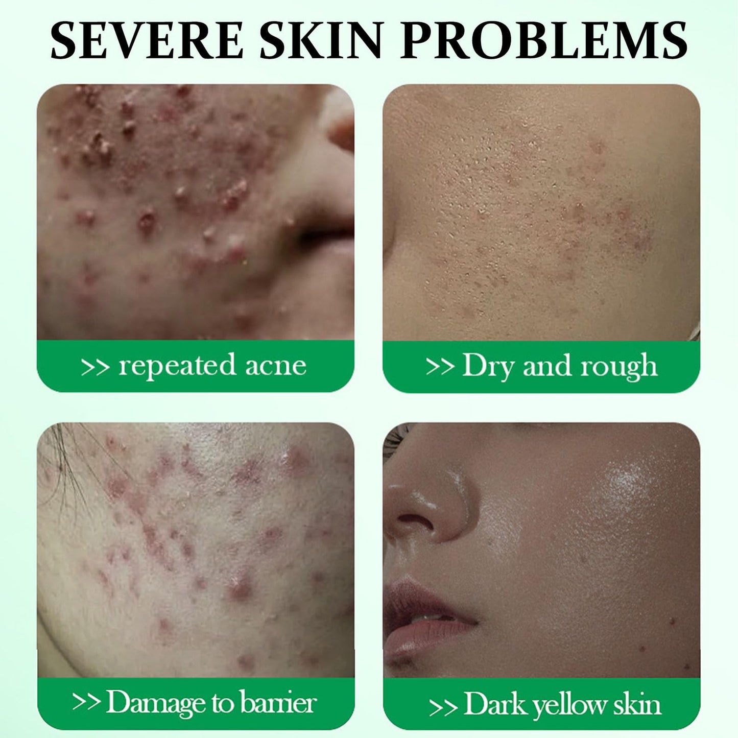 ISBEAUSOLS Salicylic Acid Acne Cream 50g - 3% BHA Spot Cream for Acne - Blackhead Remover - Dark Spot Remover for Face - Scar Removal Cream - Moisturizing Face Cream for Women - Pimple Cream for Redness