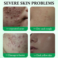 ISBEAUSOLS Salicylic Acid Acne Cream 50g - 3% BHA Spot Cream for Acne - Blackhead Remover - Dark Spot Remover for Face - Scar Removal Cream - Moisturizing Face Cream for Women - Pimple Cream for Redness
