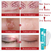 ewku Scar Removal Set with Repair Scar Cream & Serum, Stretch Mark Removal Cream for Old and New Marks, Acne Scar Treatment for Body, Trauma Scars, Scald, Hyperpigmentation & All Types of Scars
