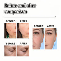 Epi-glow Advanced Anti-Hyperpigmentation Cream,Mela-nex Cream for Hyperpigmentation Treatment,Anti Aging Face Cre-am,Retinol Moisturiser,Retinol Serum for Face,Retinoid Cre-am