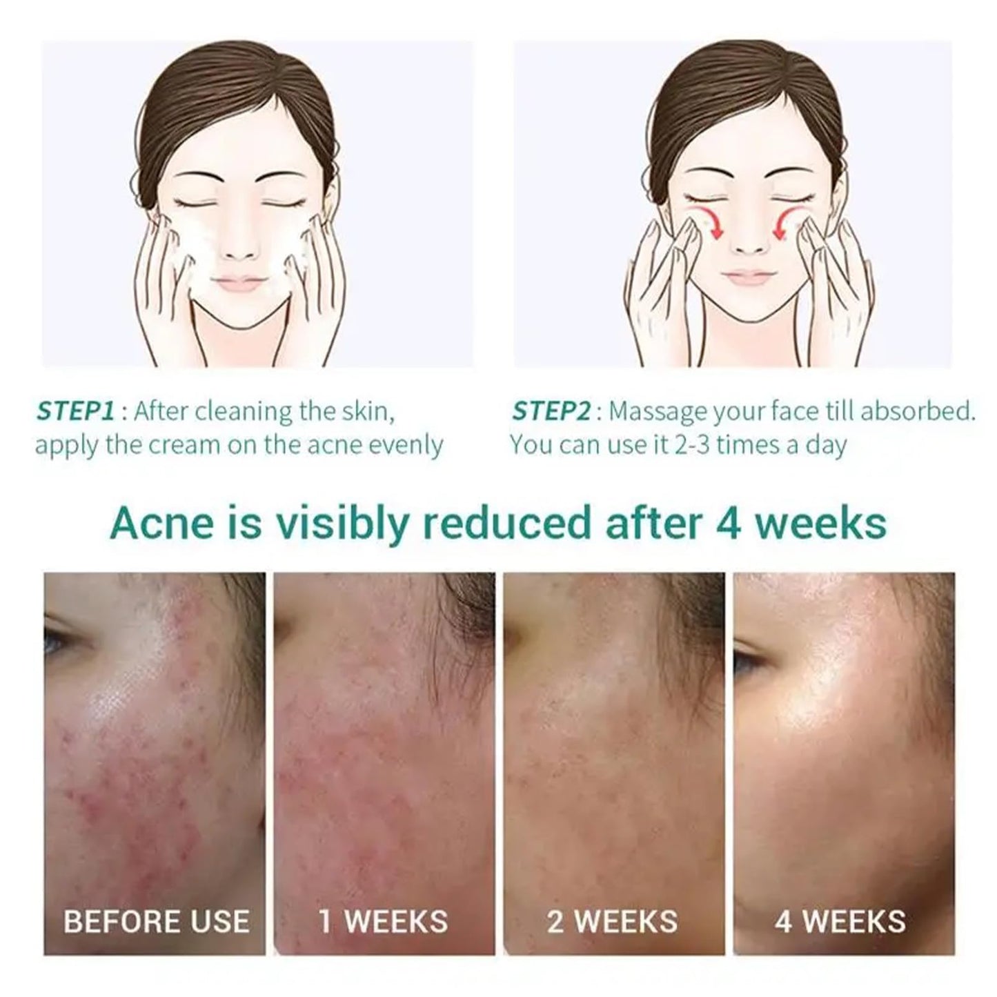 Anti Acne Face Cream, Tea Tree Face Ance Gel, Spot Cream for Acne Treatment and Spot Treatment Shrink Pores, Acne Scars Recovery,Control Sebum Secretion,Relieves Inflammation Redness & Anti-Bacterial