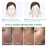 Anti Acne Face Cream, Tea Tree Face Ance Gel, Spot Cream for Acne Treatment and Spot Treatment Shrink Pores, Acne Scars Recovery,Control Sebum Secretion,Relieves Inflammation Redness & Anti-Bacterial