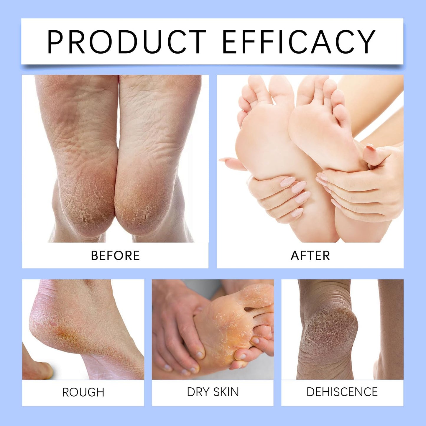 Beauthink 60% Urea Foot Cream - for Cracked Heels & Dry Skin, Cracked Heel Repair Cream For Feet and Hand, Intensive Moisturizer for Deep Hydration, Moisturize Rough on Feet, Hands & Body