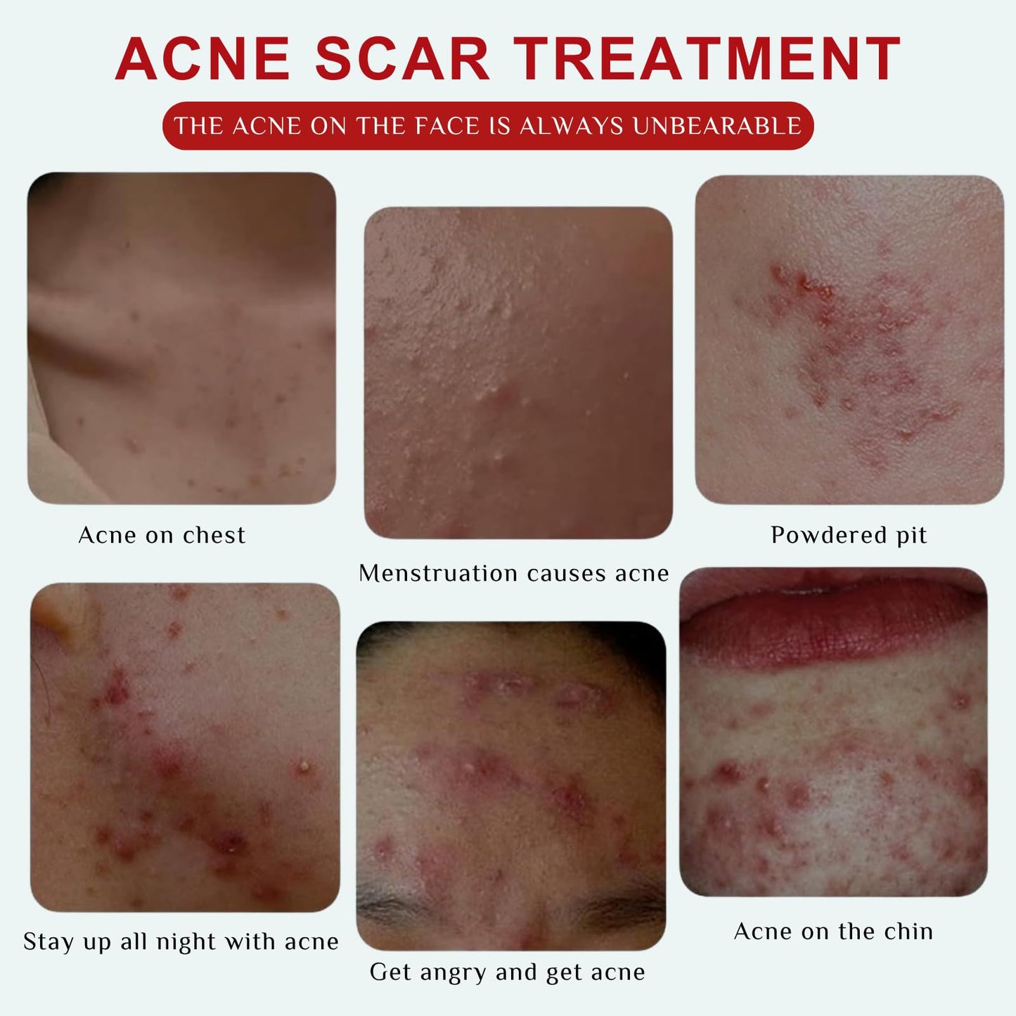 Acne Treatment Cream – Fast Acting Spot Treatment for Face - Blemish Control Cleanser Reduces Pimples, Blackheads & Blemishes - Gentle Skin Care for Oily & Acne-Prone Skin, 40g (2 Value Packs)