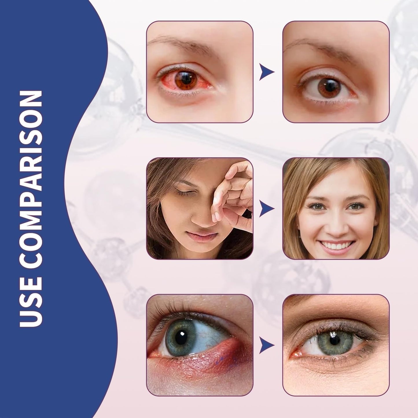 2PCS Chala/zion Eye Treatment Cream,Stye Eye Treatment,Moisturizing Cream for Eyelids,Stye Treatment for Dry Eyes,Cha/lazion Treatment for St/ye,Gentle Eyelid Cre/am for Daily Eye Care,S/tye Eye