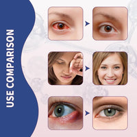 2PCS Chala/zion Eye Treatment Cream,Stye Eye Treatment,Moisturizing Cream for Eyelids,Stye Treatment for Dry Eyes,Cha/lazion Treatment for St/ye,Gentle Eyelid Cre/am for Daily Eye Care,S/tye Eye