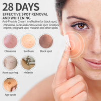 Tianyue Freckle Removal Cream,Anti-Freckle Crea-m- Dark Spot Removal Cream with Niacinamide & Vitamin C,Dark Spot Remover for Face & Body,Whitening Freckl-e Crea-m, Reduces Melasma,Improve Skin Dullness