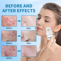 Leogony 5 PCS Serum Micro Infusion Facial System with Roller, Micro Infusion Facial System for Lips for Repair Skin Deep Nourishmen