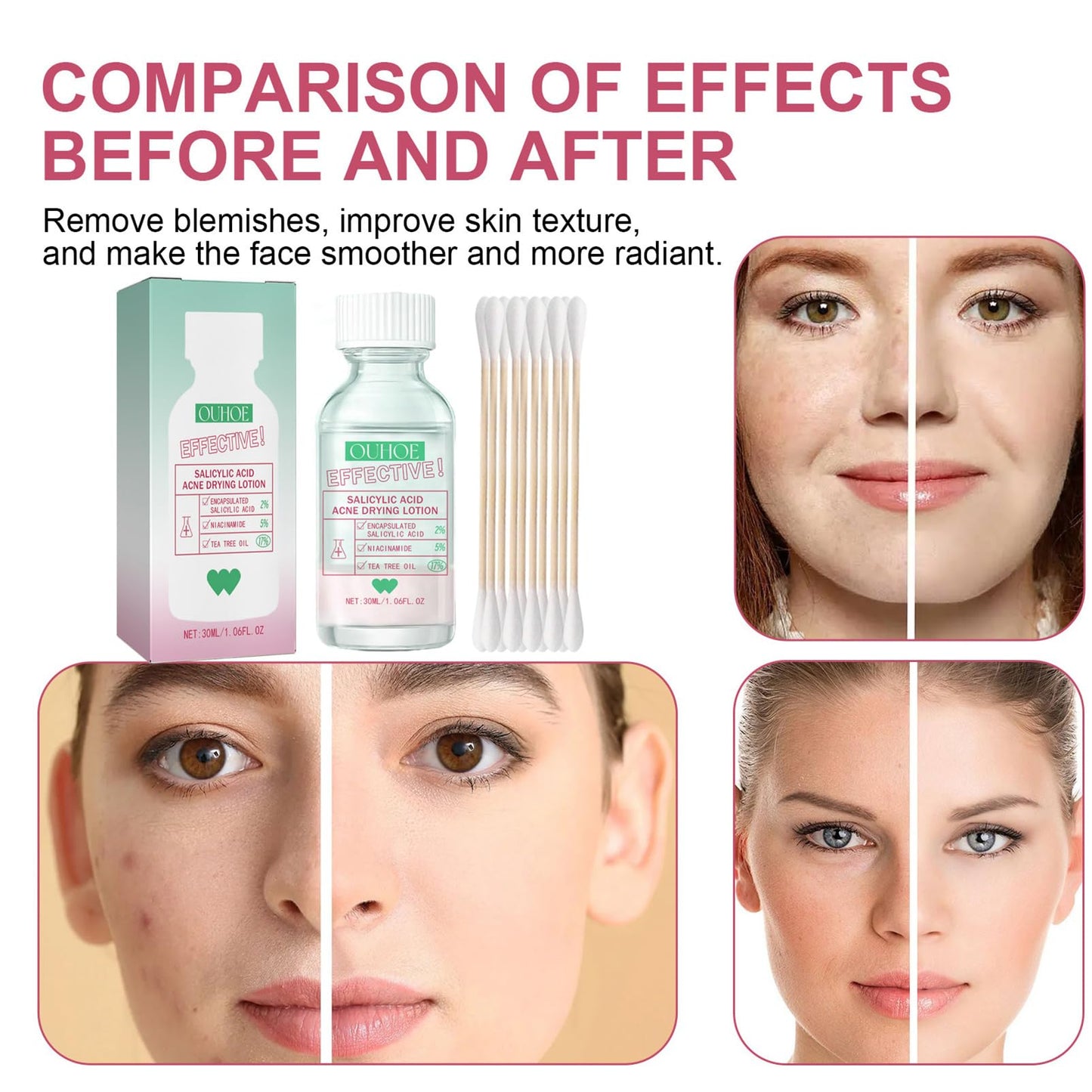 Overnight Drying Lotion, Spot Treatment for Acne, Anti-Blemish Drying Lotion For Blemishes 30ml Anti Acne Treatment Face Serum for Facial Pimples/Zits, Acne Control, Reduce Redness