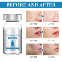 MADGININE Micro Infusion Facial System,Micro Infusion Kit,Beauty Micro Infusion Micro Infusion System Hyaluronic Acid Serum for Face Suitable for All Skin Types (3*Serum+Roller)