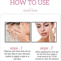 Oumun 15% Acid Acne Treatment Gel,Anti Acne Face Cream,Face Acne Treatment,Acid 15% Facial Serum Cream,Spot Treatment,Gentle Acne Cream,Spot Serum Cream for Face,Pimple Treatment Gel Cream,Face Gel for Acne