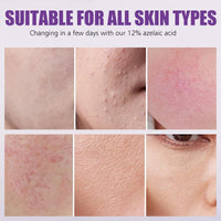 Azelaic Acid Cream, Azelaic Acid Face Serum Cream, Brightening Face Skin Care Treatment for All Skin Types, Repair Dark Spots for Fresher and Smoother Skin, (20g)