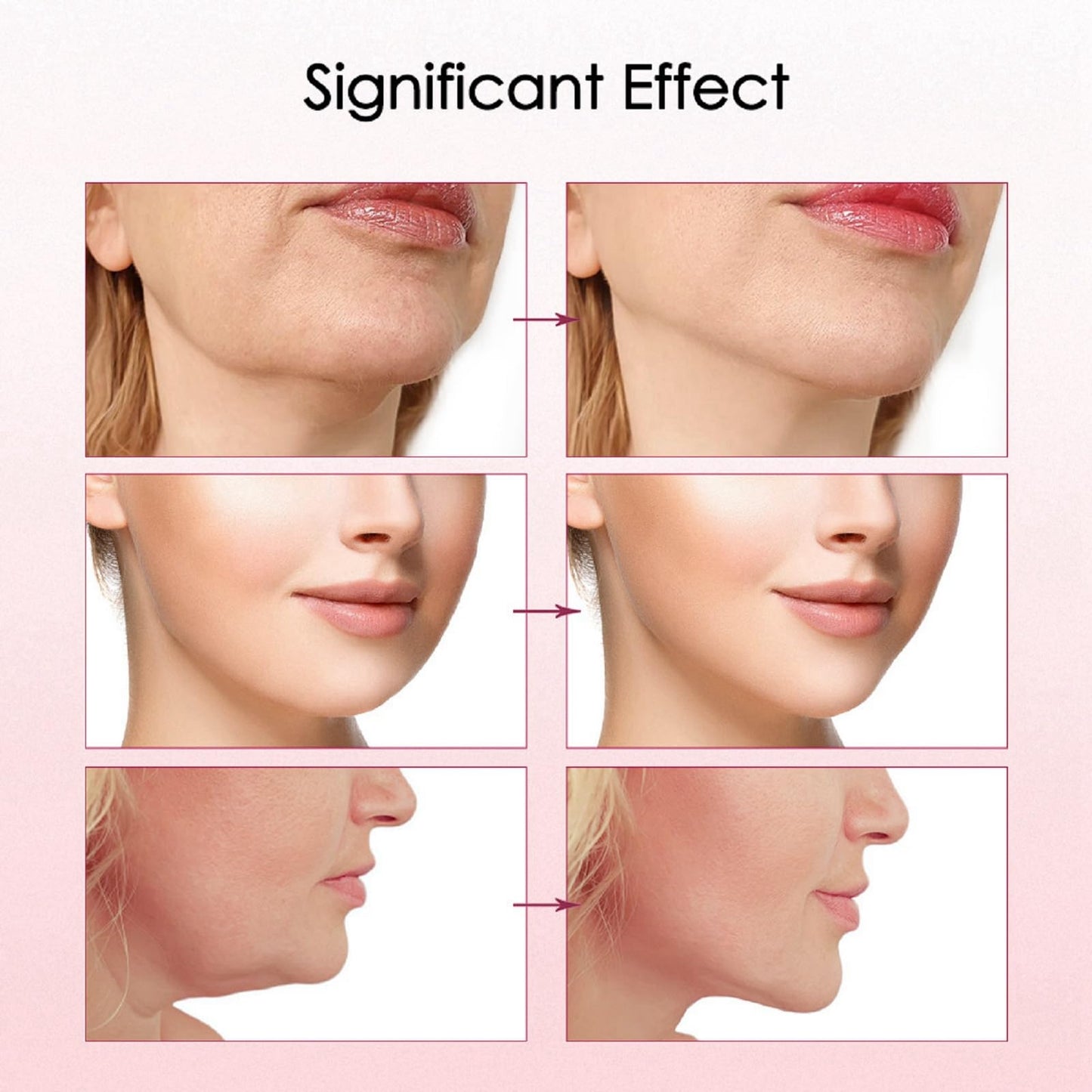 AINxtolm 5PCS Bloskin Lift Mask,Bloskin Double-Chin Mask,Face Lifting Mask,V-Line Face Mask,Nourishing Firming Face Tape,Double-Chin Reducer Lift Mask,Chin Strap for Double-Chin,Lifting Chin Mask Skincare