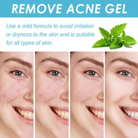 1PCS Acne treatment gel, Anti-Acne Cream, Spot Treatment Pimple Cream,Moisturizing gel for relieving and soothing redness, Acne treatment and spot treatment 20g.