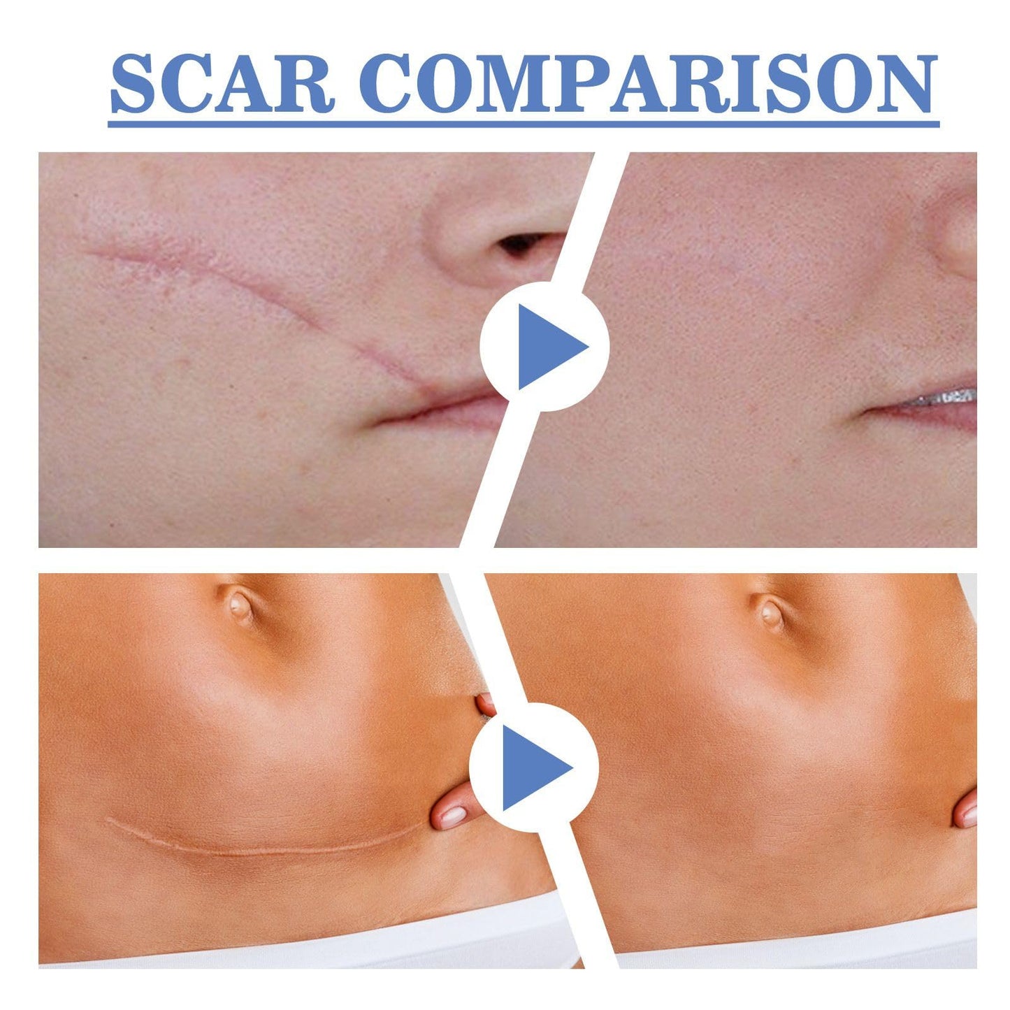 Jinjiar Scar Removal Set with Repair Scar Cream & Serum,Scar Removal Cream,Scar Treatment,Advanced Scar Gel for Old and New Scars,Scar Crea-m After Surgery,S-car Healing Cre-am,Acne Sc-ar Treatment,Scar Away