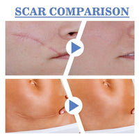 Jinjiar Scar Removal Set with Repair Scar Cream & Serum,Scar Removal Cream,Scar Treatment,Advanced Scar Gel for Old and New Scars,Scar Crea-m After Surgery,S-car Healing Cre-am,Acne Sc-ar Treatment,Scar Away