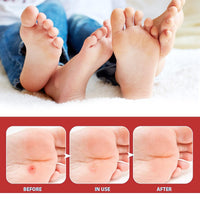SingHao 42 Pcs Wart Treatment Patch,Wart and Corn Remover Pads,Verruca Treatment,Wart Remover Corn Plasters,Corn Remover for Feet and Hand,Effective Deep Verruca Removal Pads Patches,Corn and Callus Remover