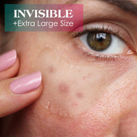 AUSLKA Blemish Patches for Chin & Cheeks -18 Patches, Hydrocolloid Patch - Blemish Patches - Zit Stickers - face Spot Dots - Zit Breakouts