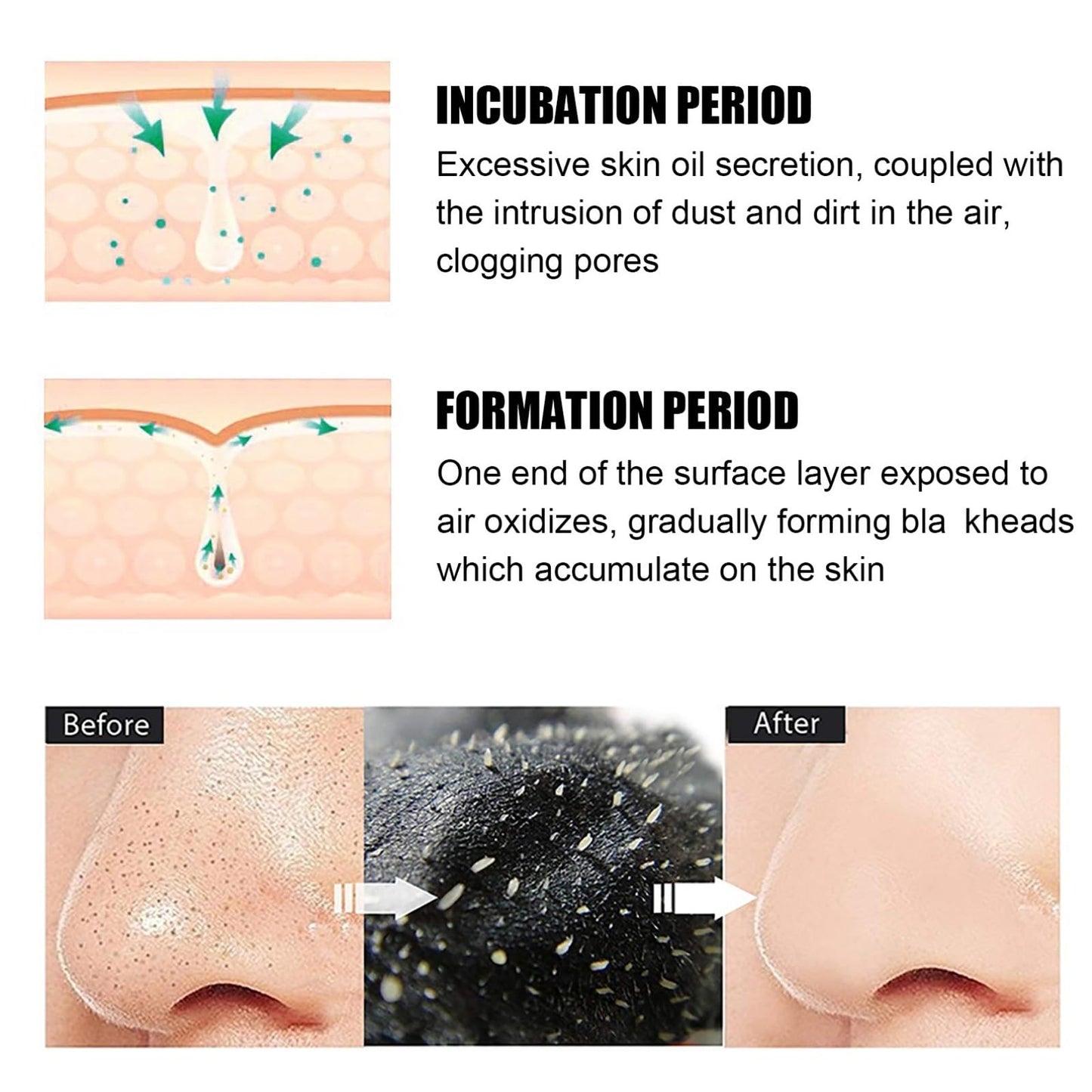 80 Pcs Blac/khead Remover Strips,Charco/al Pore Strips,Deep Cleansing Nose Str/ips Blac/khead,Nose Patches for Pores,Removes Bla/ckheads and Unclogs Po/res for Women and Men,Gentle and Skin-friendly