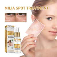 GNAUMORE Milia Spot Serum for Face,Milia Treatment under Eye,Eye Serum for Dark Circles and Puffy Eyes,Fat Granule Clearing Skin Serums,Even and Radiant Skin Generic,30ml