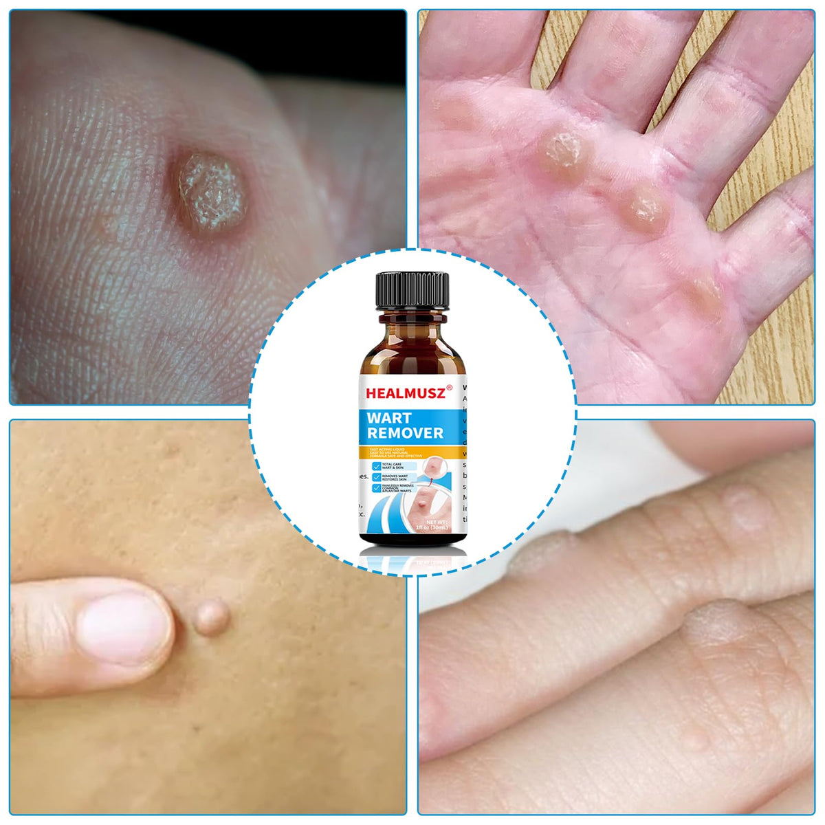 Enigmapn Wart-Remover Painless Skin and Fast-Acting, Wart-Remover for Hands and Body Fall Away Quickly, Natural Remover-15ml