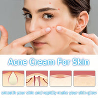 Xunzhi Acne Control Cream for Face,Acne Treatment Gel,A-cne Treatment,A-cne Face Cream,Ac-ne Gel Fast Absorbing Spot T-reatment,Anti Ac-ne F-ace C-ream,Acn-e C-ream for F-ace,Fa-ce Acn-e T-reatment