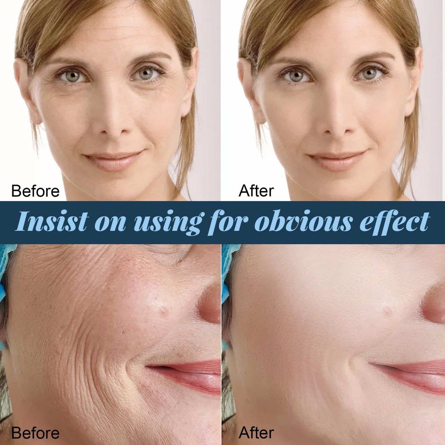 Siyinzu 2PCS Chin-Ology Double Chin Lifting Mask,Chino-logy Chi-n Mask with Hyaluronic Acid,V Line Face Lifting Ch-in Ma-sk,Face Lift Tape,Double Ch-in Reducer for Women,Collagen Face Masks Skincare